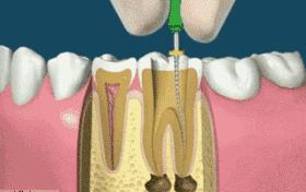 牙龈萎缩牙齿松动中医有什么方法,牙齿松动怎么办教你一招恢复