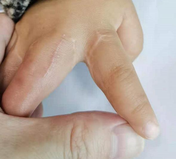 并指畸形免植皮案例,并指畸形