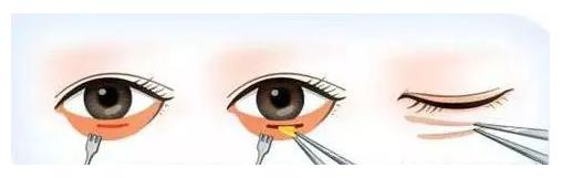 眼袋显老10岁三种方法帮助改善,眼袋显老怎么解决