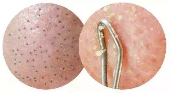 毛孔粗大如何改善不用护肤品,毛孔粗大怎么办不花钱