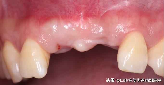 展评优秀病例赏析|Asc全瓷角度基台一体冠进行种植前牙美学修复