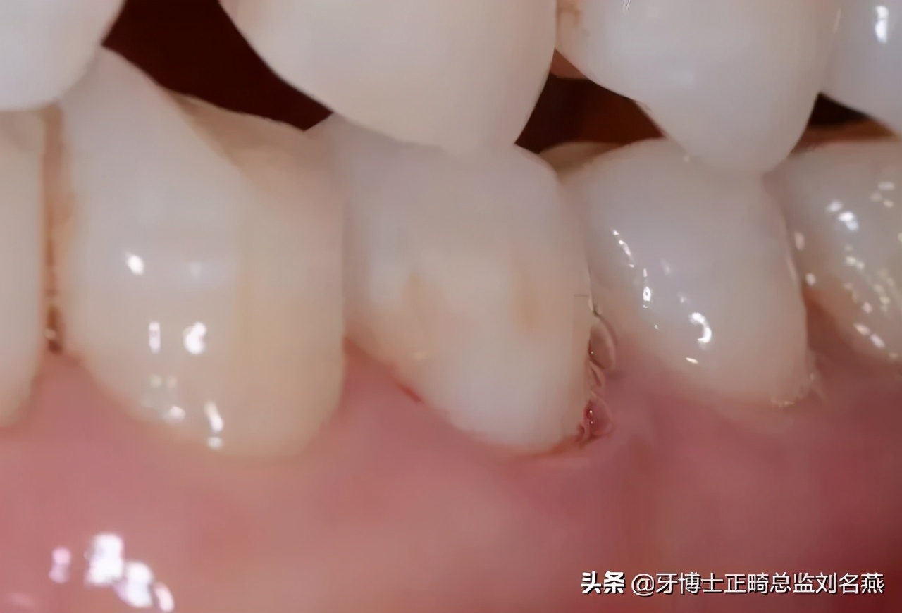 楔状缺损怎么修补,楔状缺损充填视频