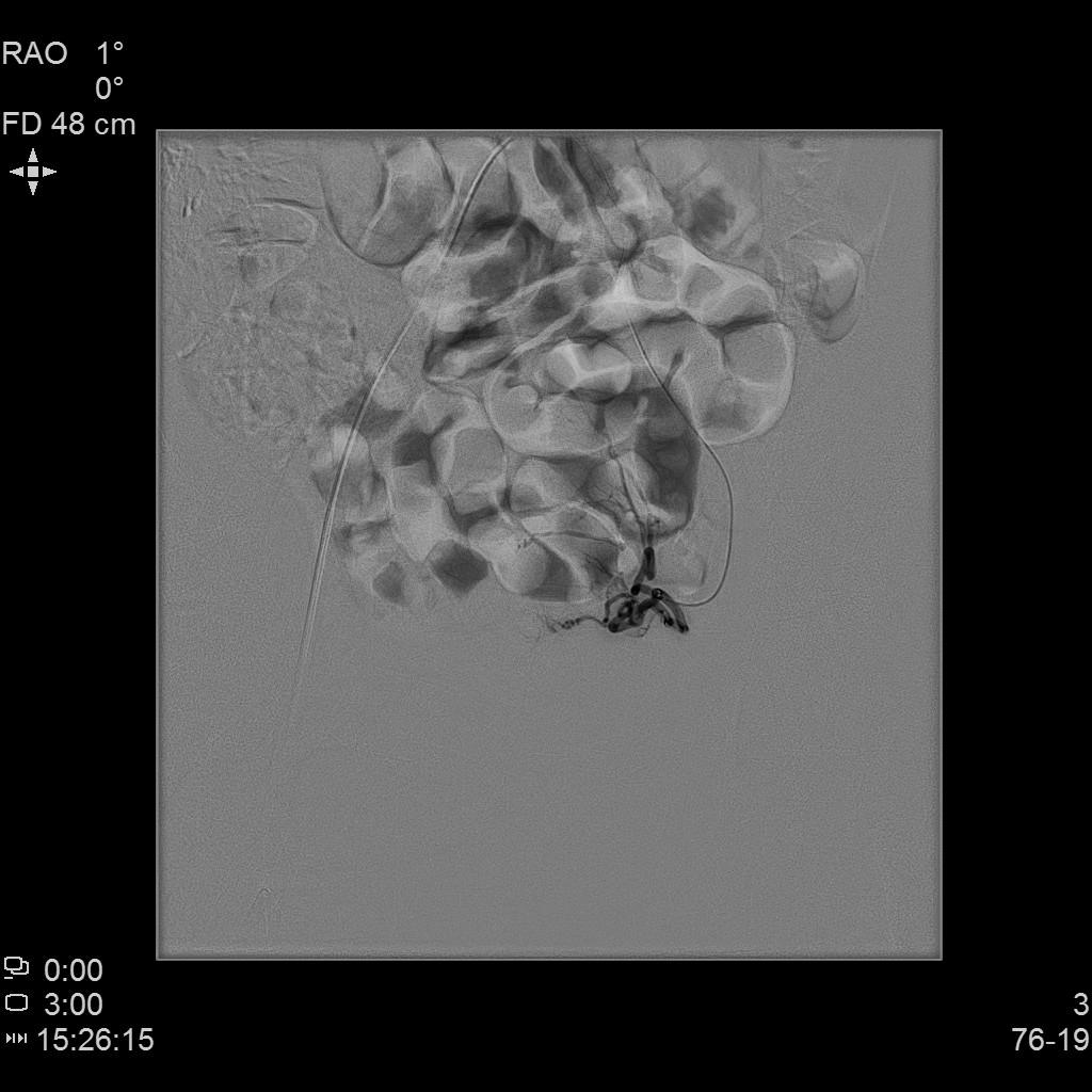 「不死的癌症」之克星——子宫腺肌症介入栓塞治疗