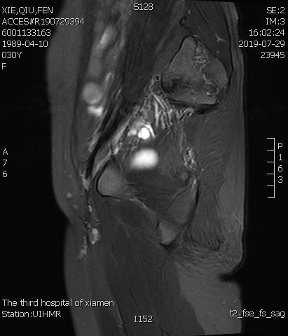 子宫腺肌症「不死的癌症」——介入栓塞来帮忙