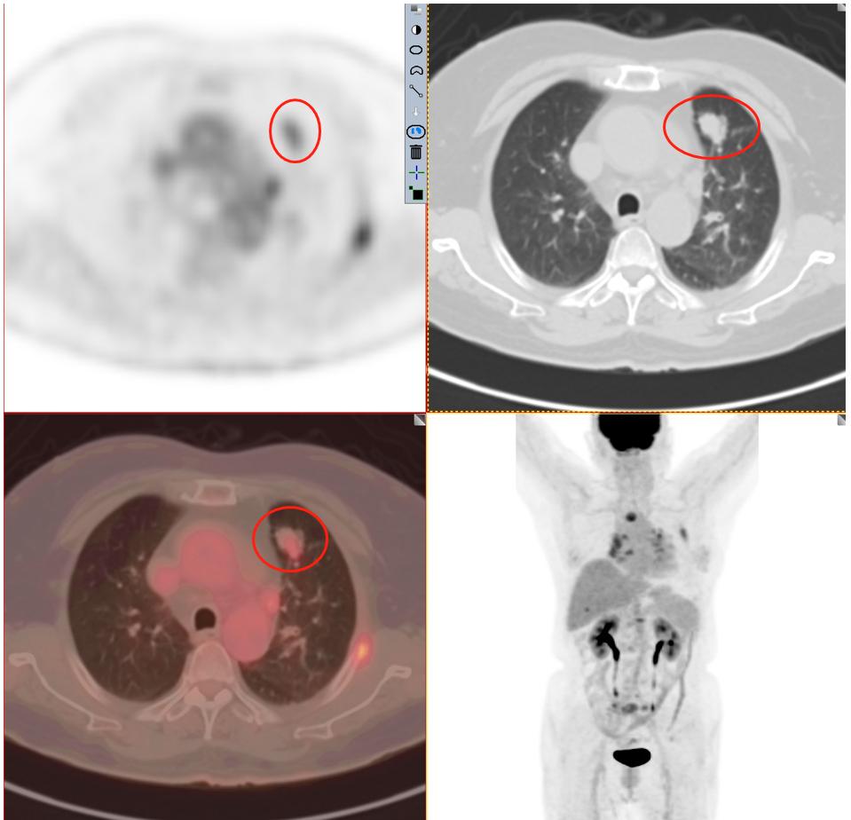 肺结节检查是薄层ct还是三维重建,肺结节检查用什么ct