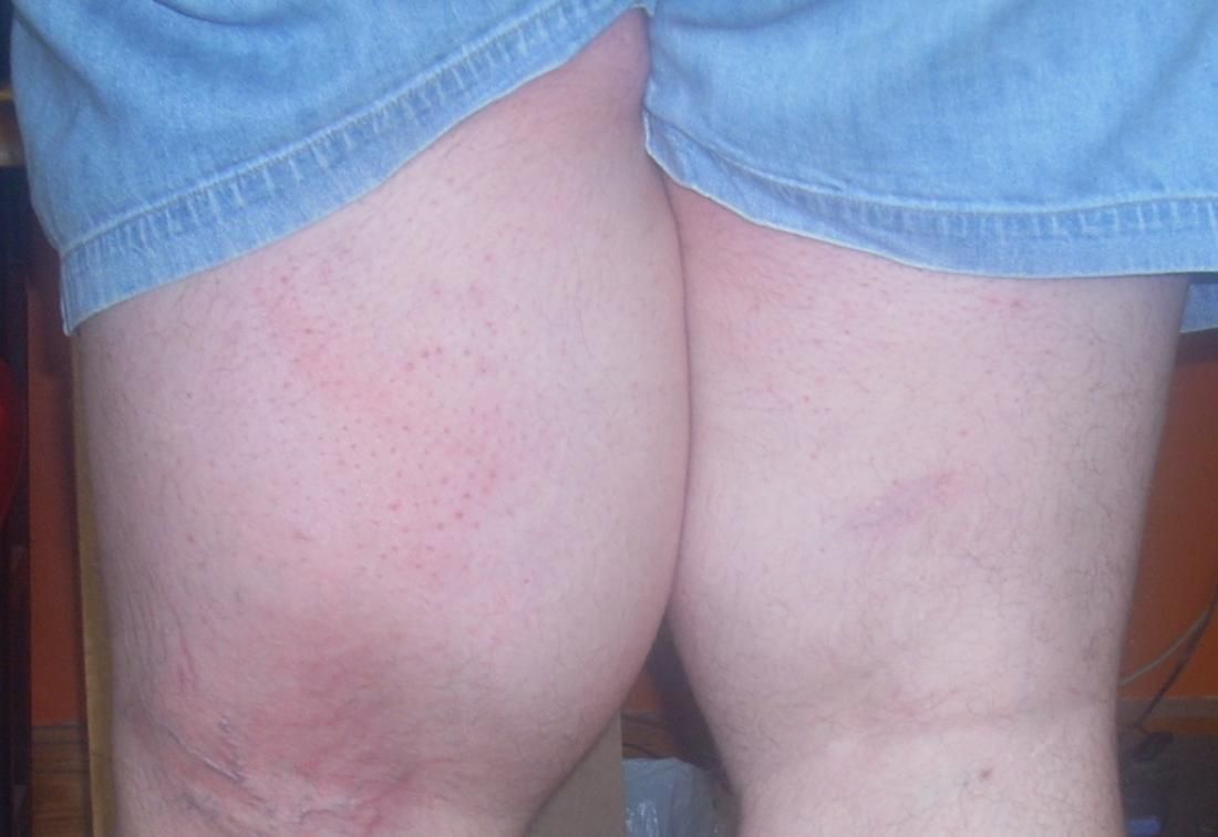 脂肪肉瘤和脂肪瘤怎么分辨,脂肪瘤很常见吗