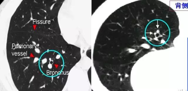 肺部ct十大征象,肺部ct正常图和异常图的区别