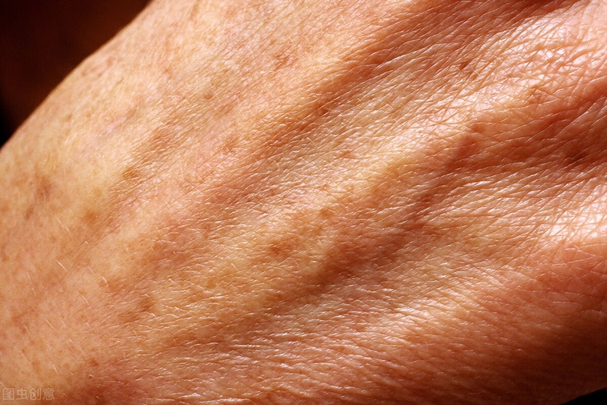 十年老年斑容易去掉么,去掉老年斑有什么好办法吗