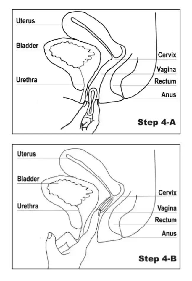 避孕环的年限是多少,既安全又轻的避孕环