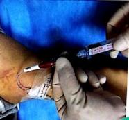 PICC冲管不当导致堵管，正确冲封管，你真的会了吗？