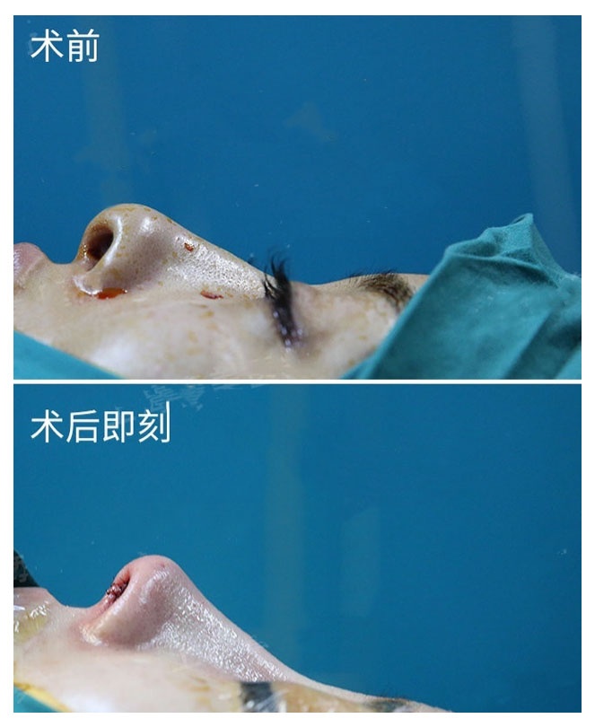 30岁怎么解决鼻翼两边下垂,鼻翼下垂但是中庭长怎么整容