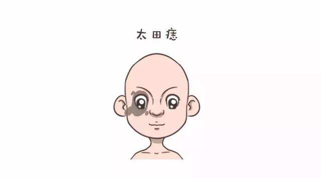 宝宝一出生就有雀斑样痣吗,出生的婴儿皮肤有黑斑怎么回事