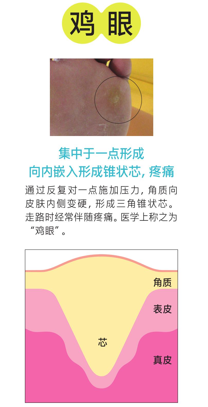 硬邦邦的老茧，会痛的鸡眼，日本皮肤科专家教你矫正足部恶习