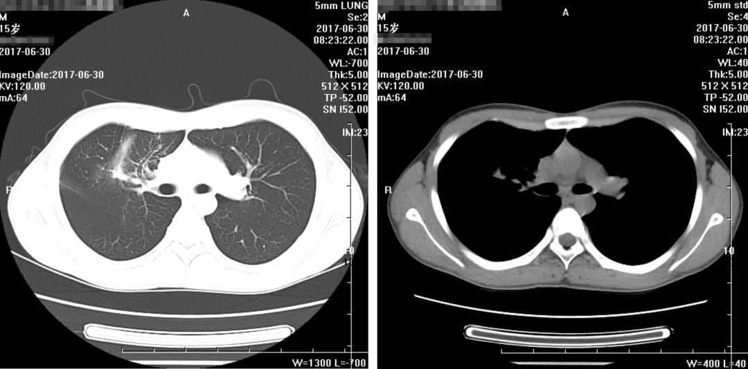 如何在CAP初始治疗后72h内进行病情评价？其成功关键有哪些？