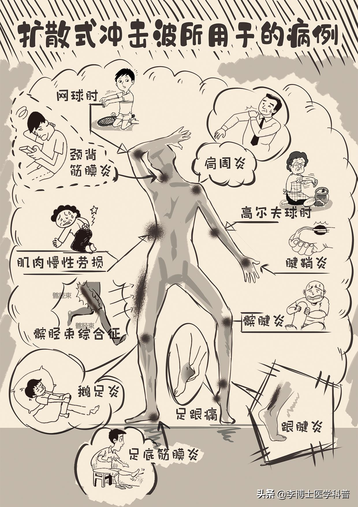 脚后跟骨刺冲击波治疗10次,冲击波治疗脚跟骨刺有效果吗