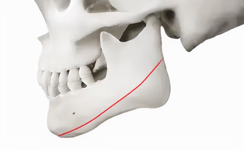 高角型下颌后缩什么样子,高下颌角后缩怎么矫治