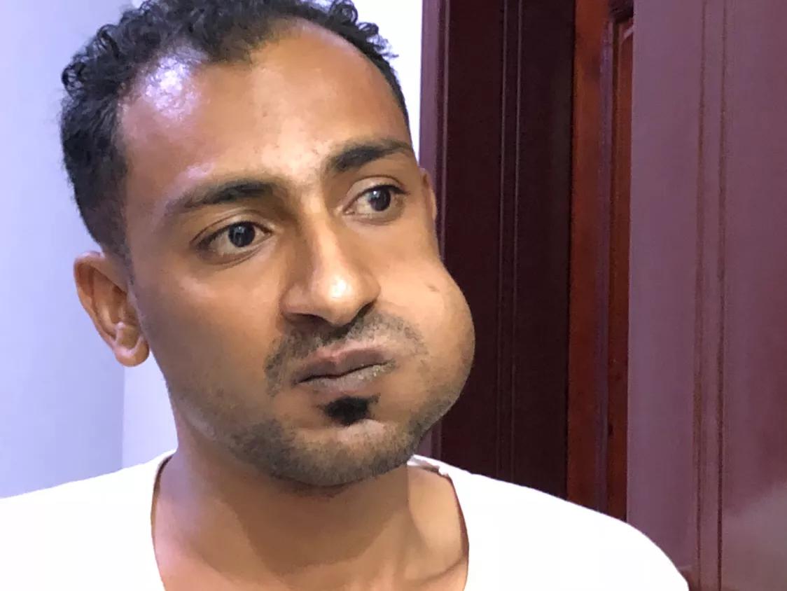 也门人腮帮子鼓起,也门人为什么嘴巴一边鼓起