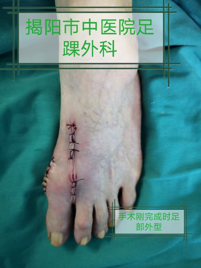 关注足部的健康,关注足部健康