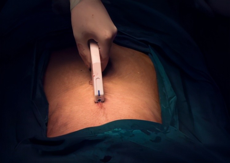 剖腹产妈妈注意事项,剖腹产妈妈应该注意什么