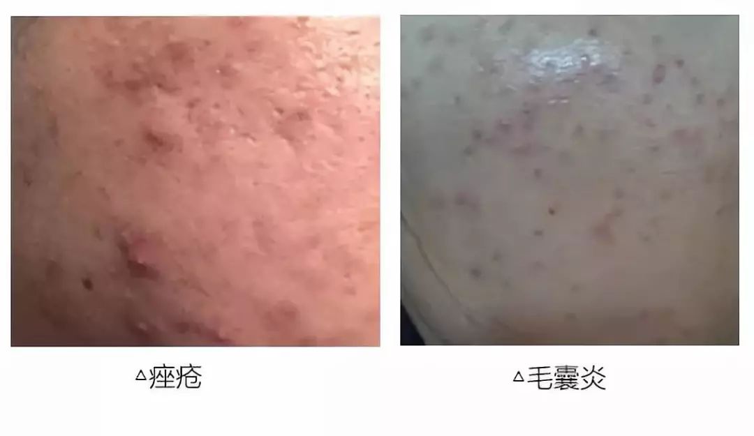 毛囊炎要不要清痘,脸毛囊炎和痘痘的区别