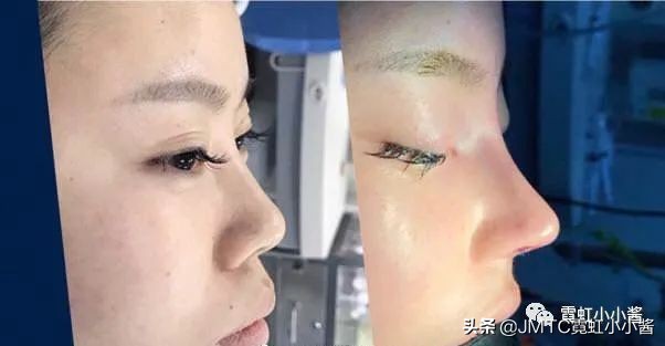 鼻子怎么修复好看呢,鼻型修复方法大全