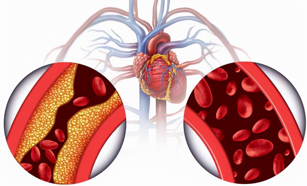 高血压和高脂血的区别,高血压可怕还是高脂血症可怕