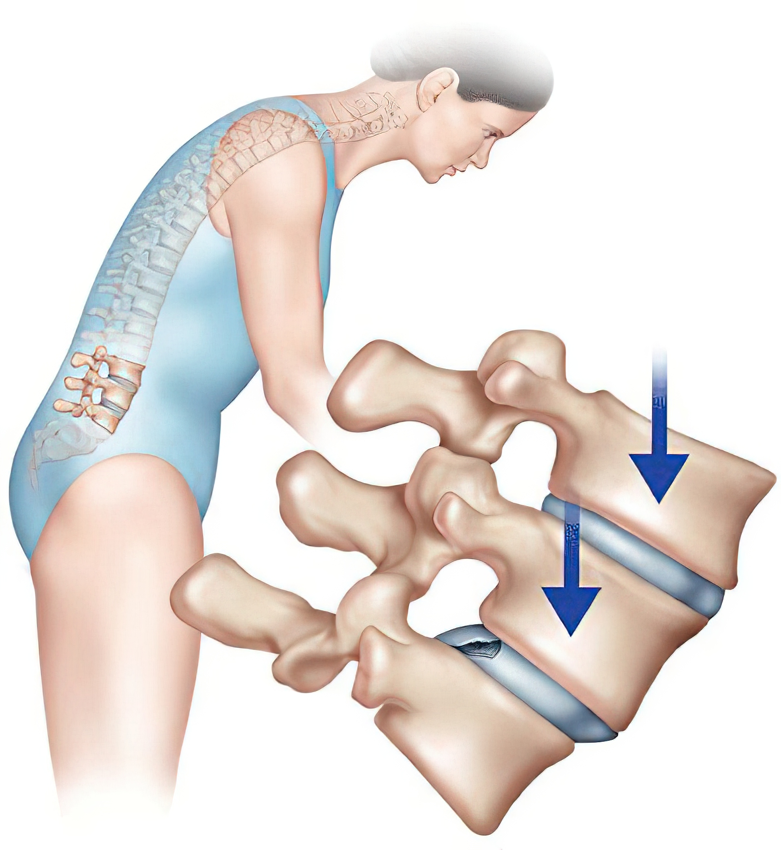 腰椎生理性曲度变直怎么治疗恢复,如何有效的避免腰椎曲度变直