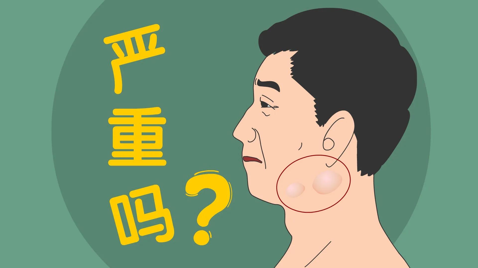 颈部摸到淋巴结凸起是肺坏了吗,颈部淋巴结肿大良性和恶性的区别