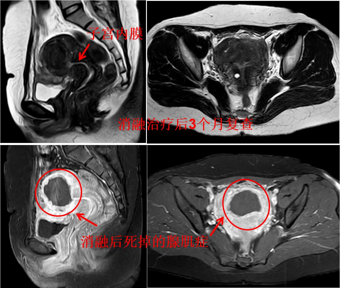 看看痛不欲生的子宫腺肌症痛经专业领域的看法与典型病例