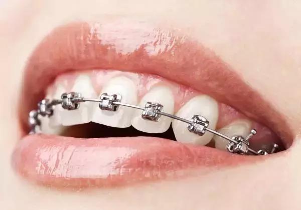 牙齿矫正你还在等什么,牙齿矫正对你最大的改变