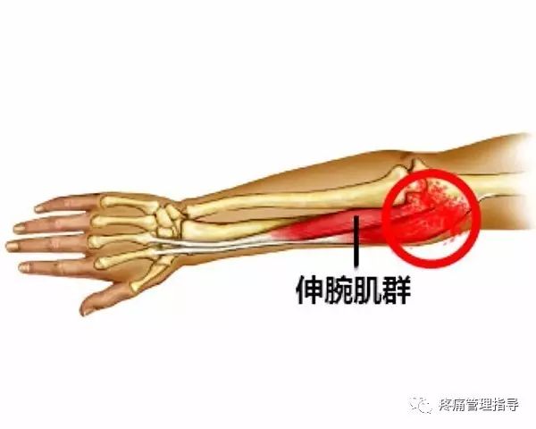 网球肘能自我恢复吗,网球肘病因的解剖学研究