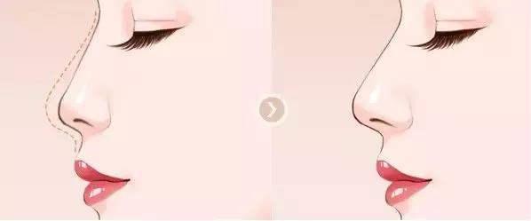 鼻部整形失败修复,鼻部整形失败案例图片