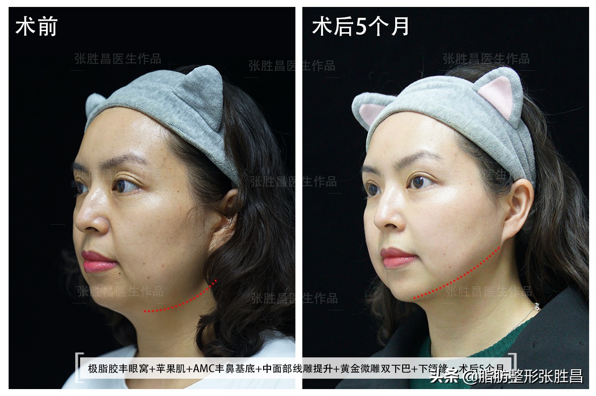 爱笑的女孩笑起来法令纹很明显,笑的时候有法令纹的人怎么样