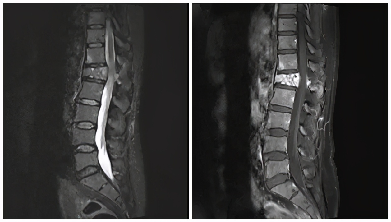 文登整骨医院脊柱微创手术怎么样,文登整骨脊柱微创