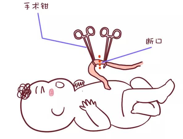 剖腹产要挨几刀、缝几层？