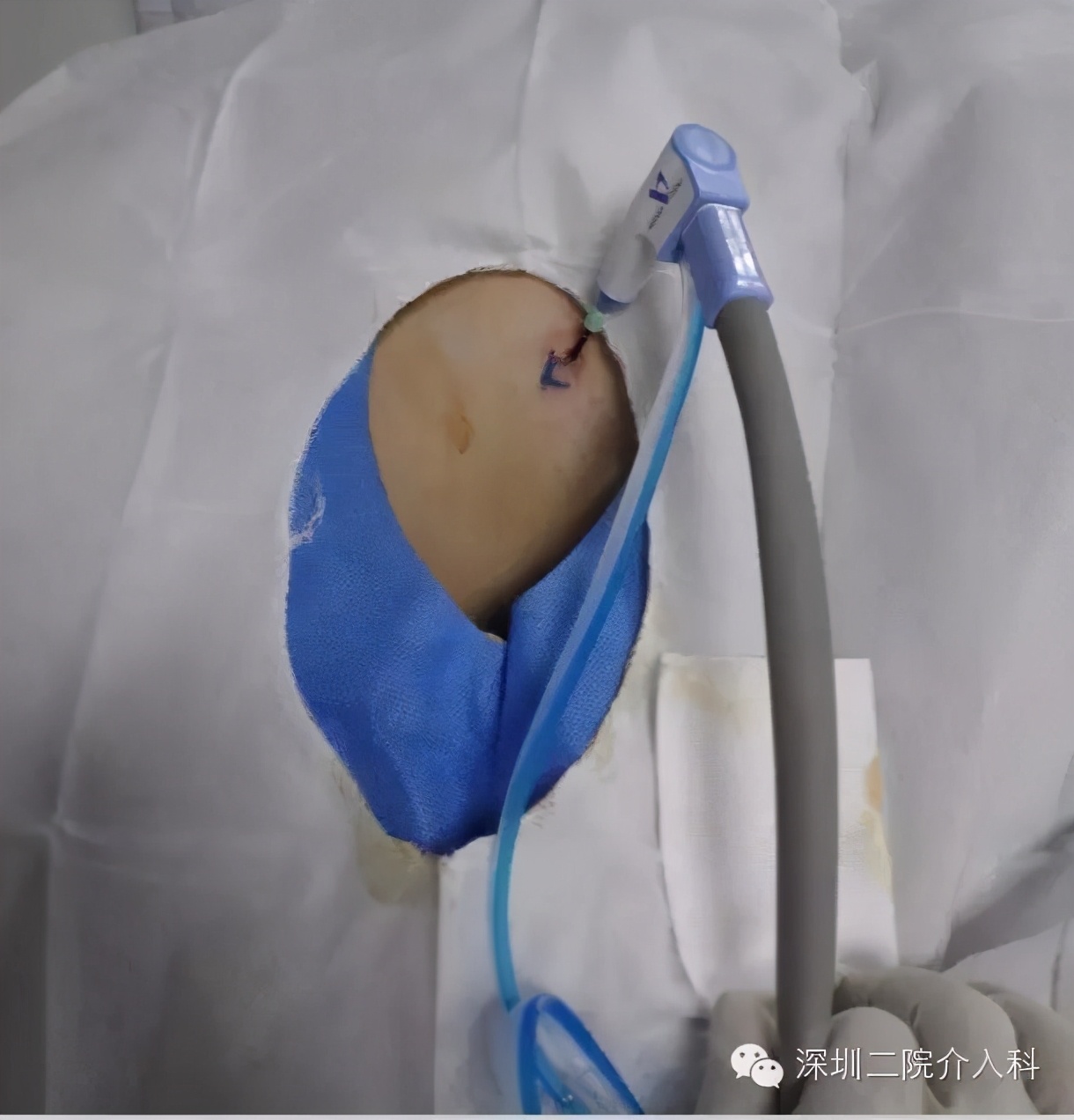 “冬季里的一把火”——恶性肿瘤的微波消融术