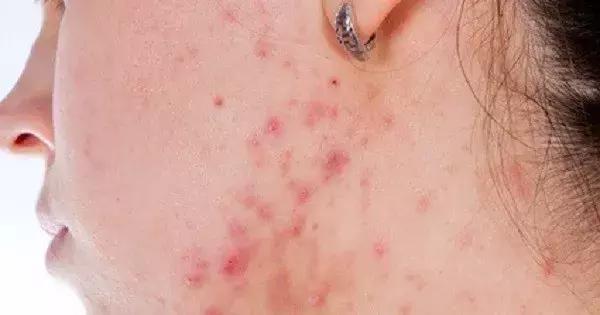 大油皮为啥还起皮,油皮是什么原因导致的怎么解决