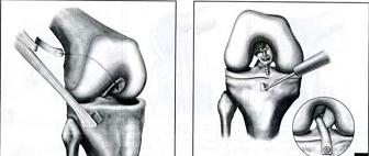 膝关节前叉韧带损伤最佳恢复方法,膝关节前韧带断了必须手术吗