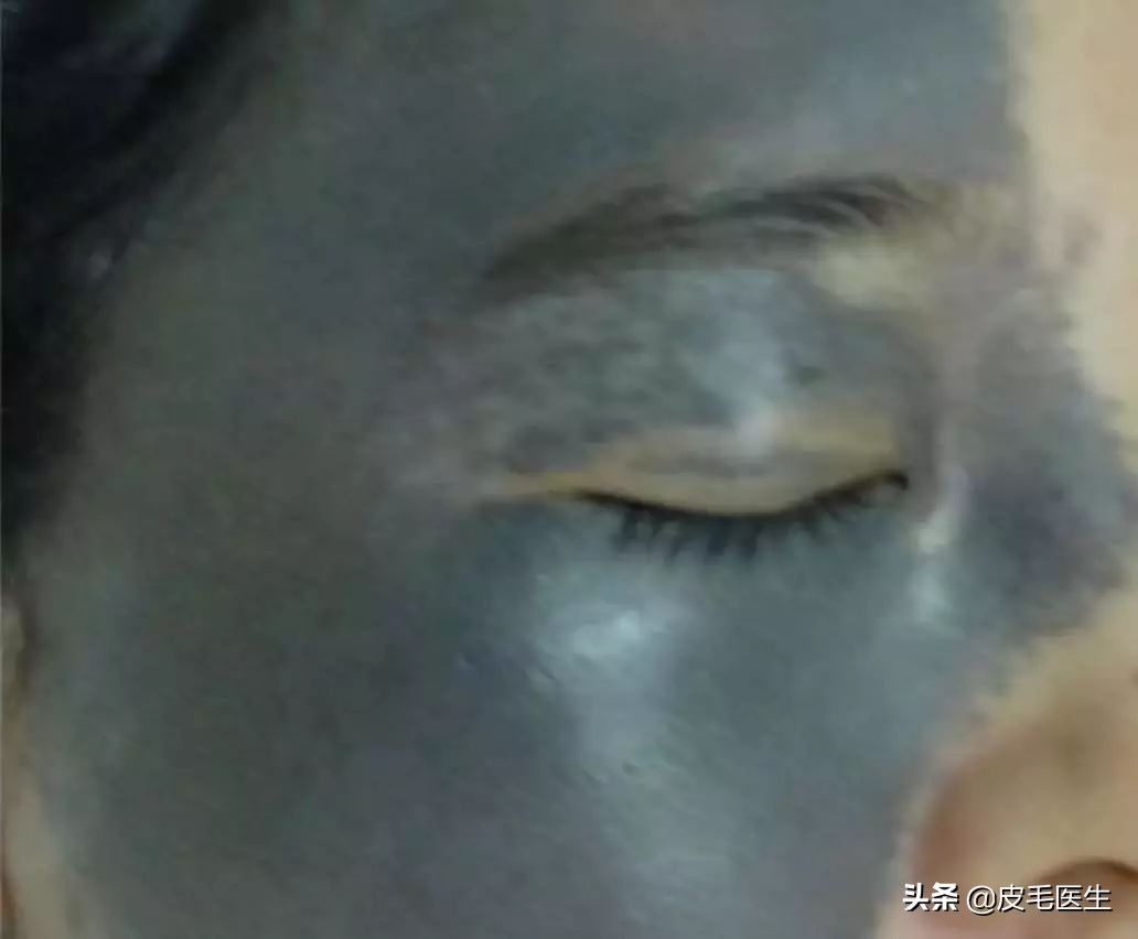 雀斑黄褐斑老年斑祛斑方法,褐斑老年斑怎么治疗效果最好