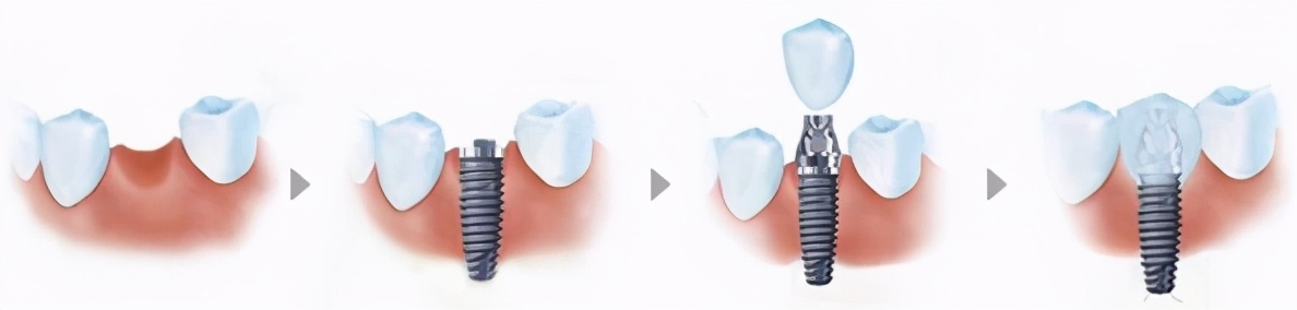 上海牙齿松动怎么修复,牙齿松动修复固齿医院