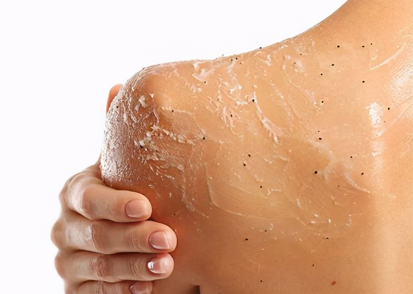 太苦了太苦了，背后长痘的女生都太苦了