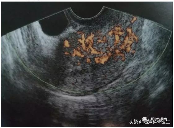 妇科常见疾病的超声诊断视频,超声常见疾病