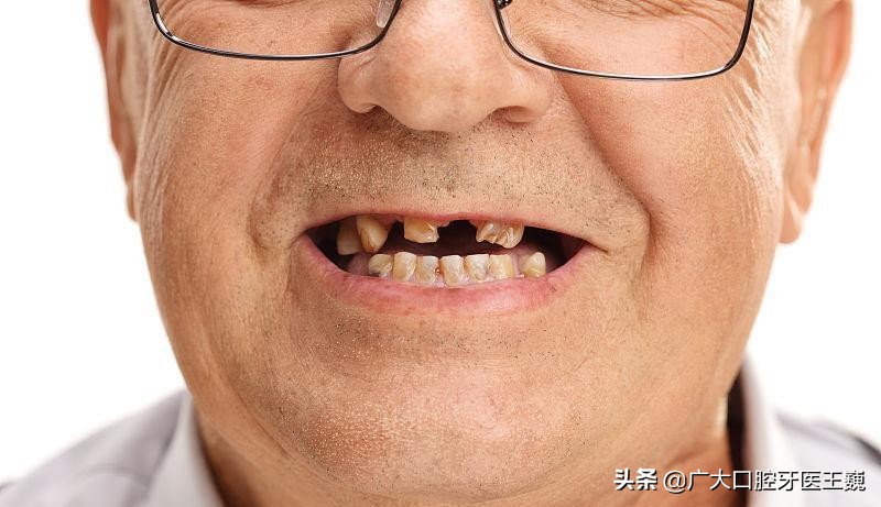 烂牙残根不拔的危害大吗,多的烂牙残根不拔的危害大吗