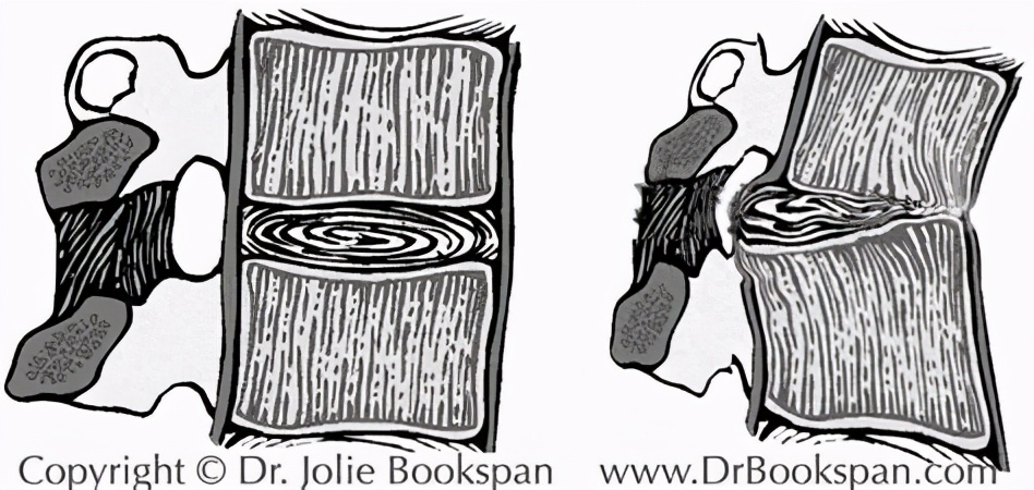 腰椎间盘突出不建议手术怎么办,腰椎间盘突出怎样才达到手术标准