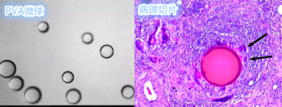 子宫肌瘤介入栓塞造影剂作用,子宫肌瘤介入栓塞有副作用吗