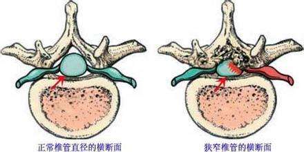 椎间盘突出腰痛时在家怎么办,椎间盘突出腰痛最快恢复方法