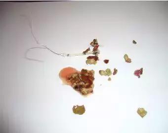 从尿道口取结石全过程,最先进的结石处理方法