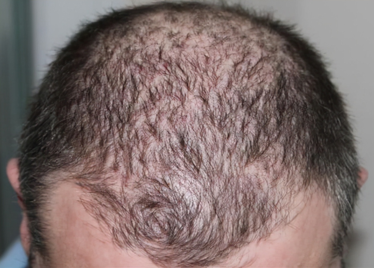 非那雄胺治疗雄激素脱发,雄激素脱发只吃非那雄胺有效果吗