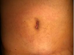 15岁少年腹中20公斤巨瘤,39岁女子腹中30斤巨型肿瘤