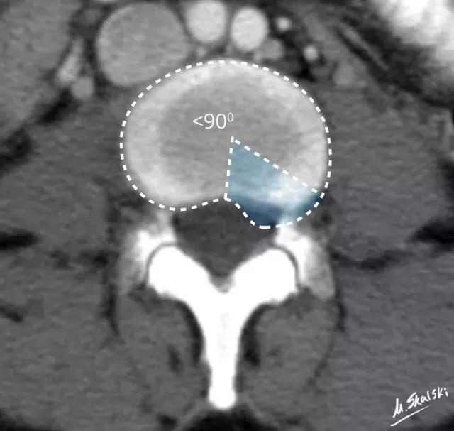 椎间盘脱出和突出片子怎么看,椎间盘膨出的鉴别诊断